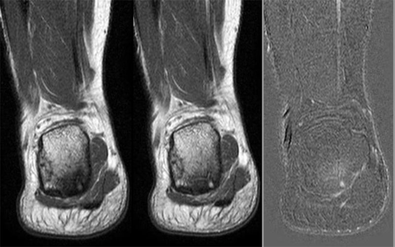 imagerie-pathologie-arriere-pied-r-ponse-cas-6